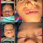 जन्मजात समस्या से राहत, चिरायु योजना ने बच्चों के चेहरे पर लौटाई मुस्कान🔥